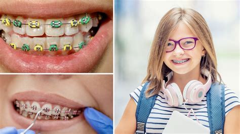 Ventajas de los brackets de cerámica vs brackets metálicos 